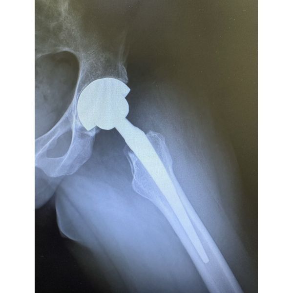 Тазобедренный сустав после протезирования