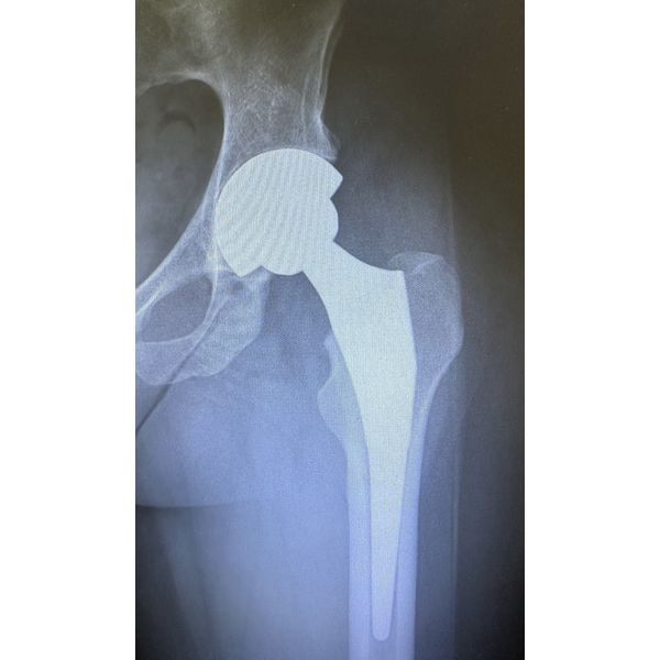 Тазобедренный сустав после протезирования