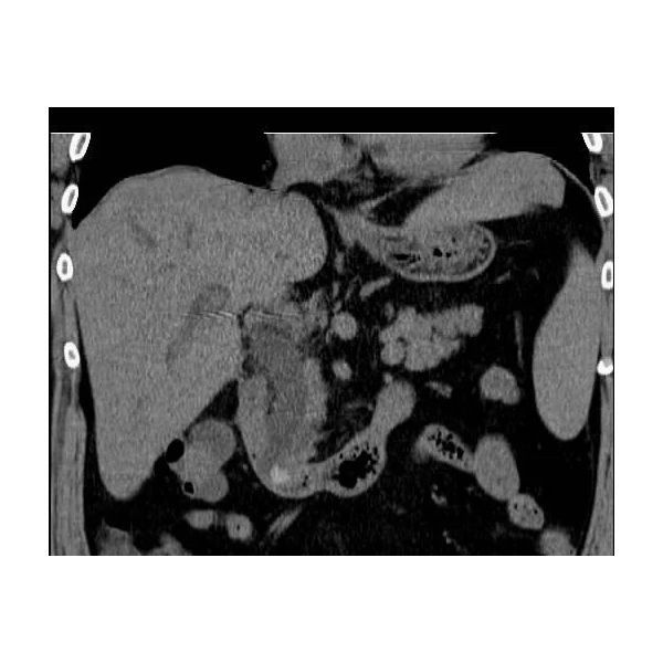 КТ-картина камней в расширенном общем желчном протоке