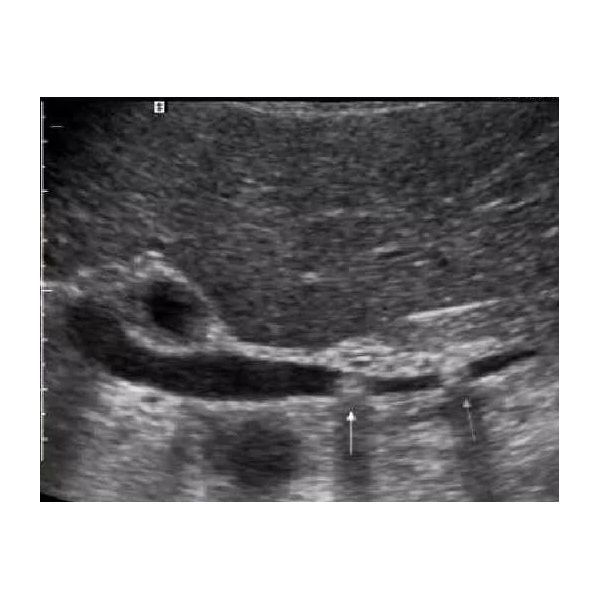 УЗ-признаки камней в расширенном общем желчном протоке