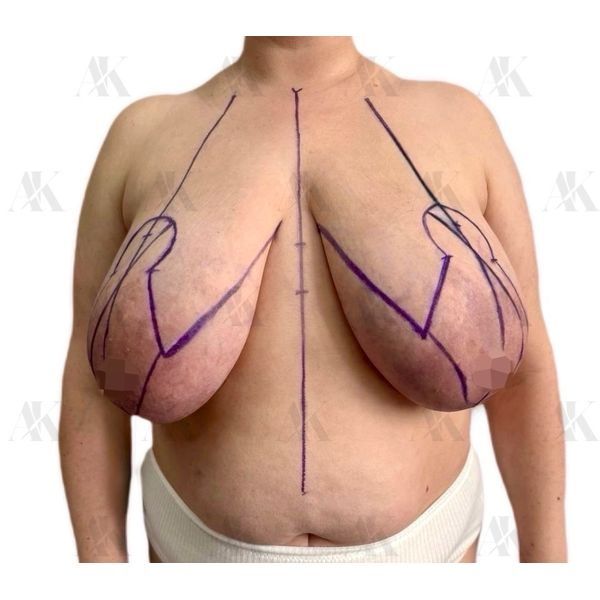 Грудь до операции (прямая проекция) Грудь до операции (прямая проекция)