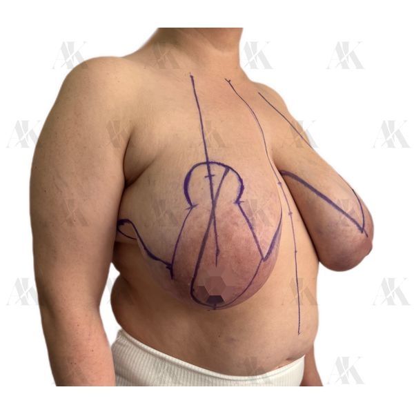 Грудь до операции (полубоковая проекция) Грудь до операции (полубоковая проекция)