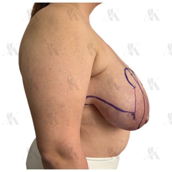 Грудь до операции (боковая проекция) Грудь до операции (боковая проекция)