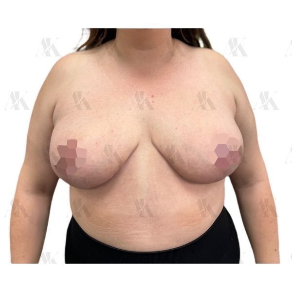 Грудь через 1,5 месяца после операции (прямая проекция) Грудь через 1,5 месяца после операции (прямая проекция)