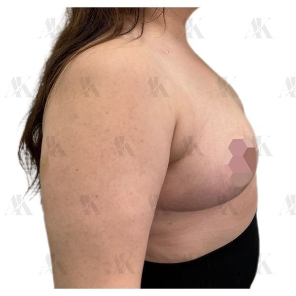 Грудь через 1,5 месяца после операции (боковая проекция) Грудь через 1,5 месяца после операции (боковая проекция)