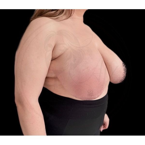 Грудь до операции (полубоковая проекция)