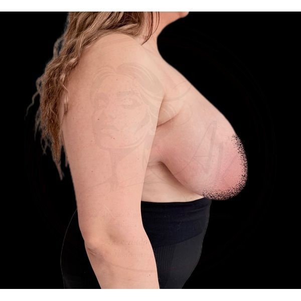 Грудь до операции (боковая проекция)