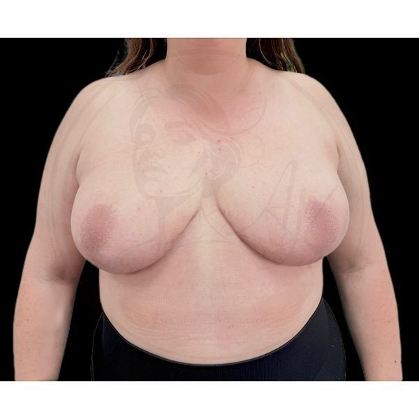 Грудь через 5 месяцев после операции (прямая проекция)