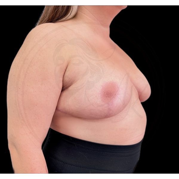 Грудь через 5 месяцев после операции (полубоковая проекция)