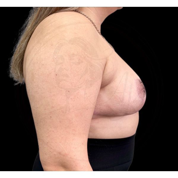 Грудь через 5 месяцев после операции (боковая проекция)