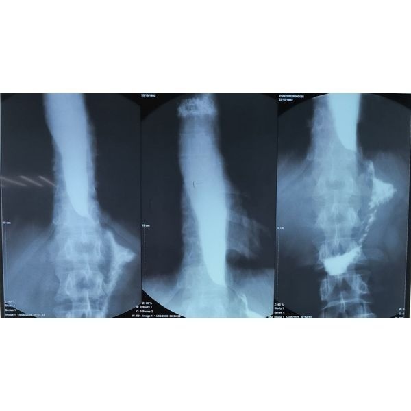 Рентгеноскопия пищевода и желудка до операции