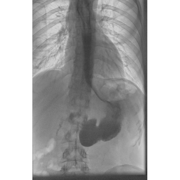 Рентгеноскопия пищевода и желудка после операции