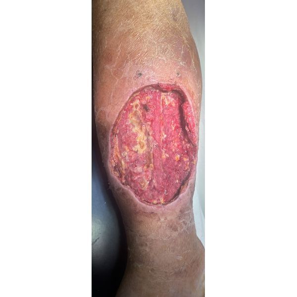 Состояние раны после второй хирургической обработки с применение VAC-терапии Состояние раны после второй хирургической обработки с применение VAC-терапии