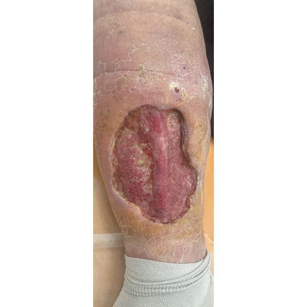 Состояние раны через две недели после поступления Состояние раны через две недели после поступления