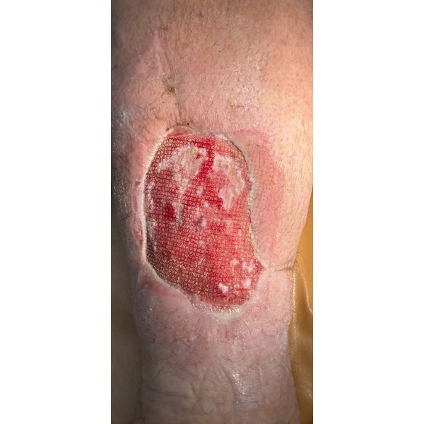 Состояние раны при повторной госпитализации после первой хирургической обработки с применением VAC-терапии Состояние раны при повторной госпитализации после первой хирургической обработки с применением VAC-терапии