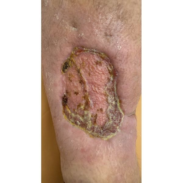 Состояние раны на 13-й день после аутодермопластики Состояние раны на 13-й день после аутодермопластики