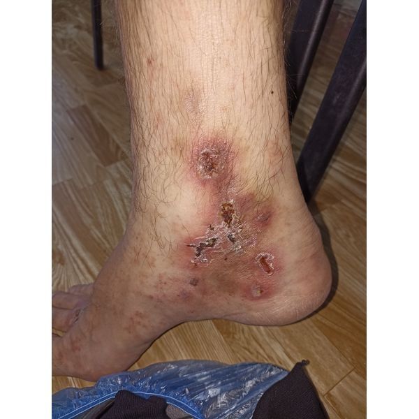 Высыпания на 4-й день терапии