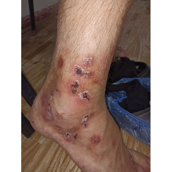 Высыпания на 4-й день терапии