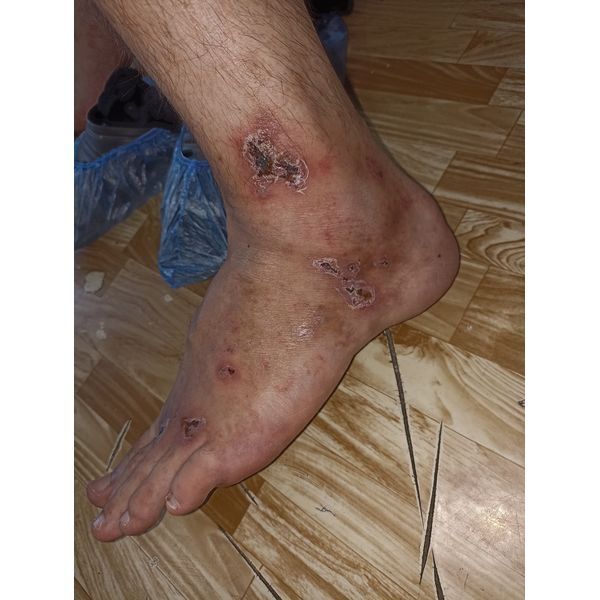 Высыпания на 4-й день терапии