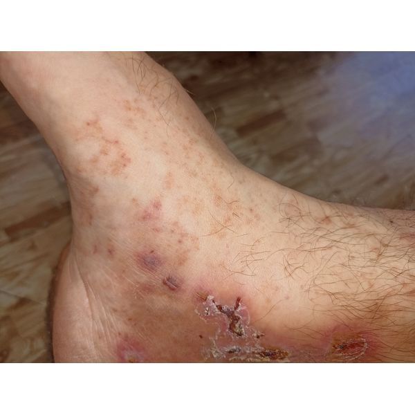 Высыпания на 4-й день терапии