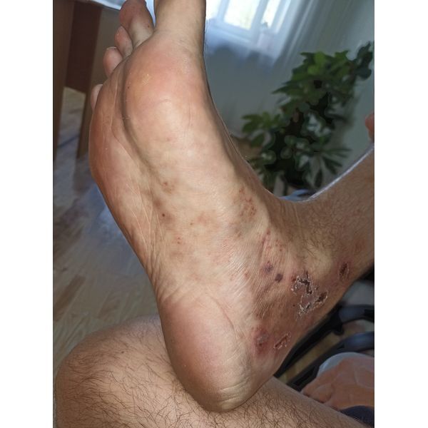 Высыпания на 4-й день терапии