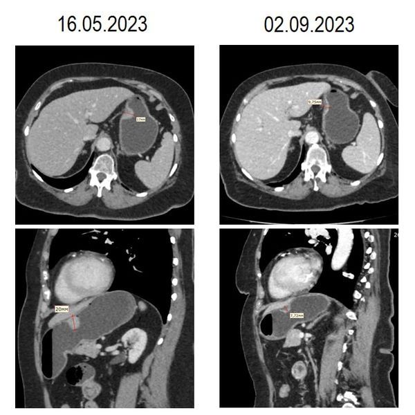До и после химиотерапии