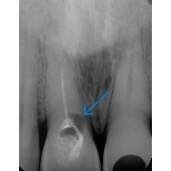 Перелом зуба 