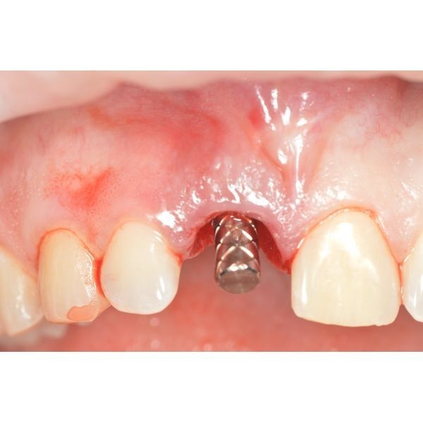 Установленный имплантат 