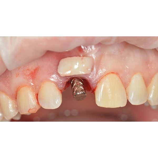 Пластика десны