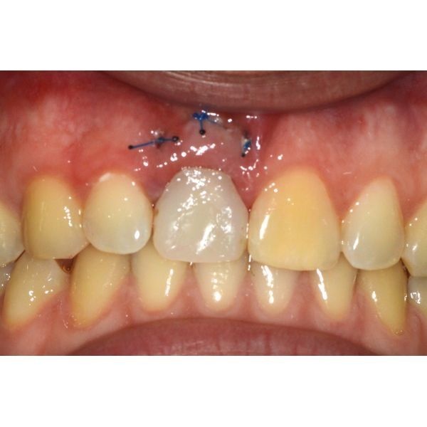 Установка временной коронки сразу после операции