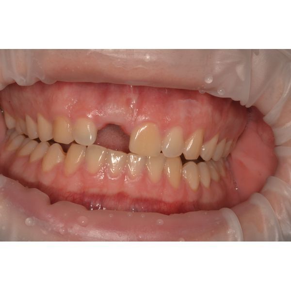 Состояние десны после удаления зуба