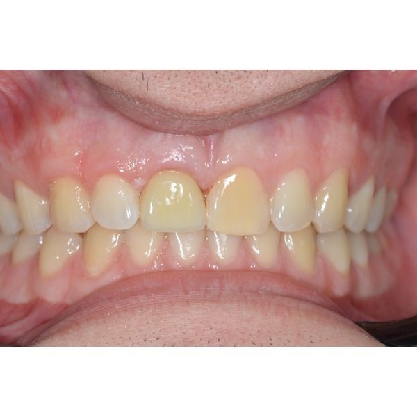 Постоянная коронка, которую установили через 3 месяца