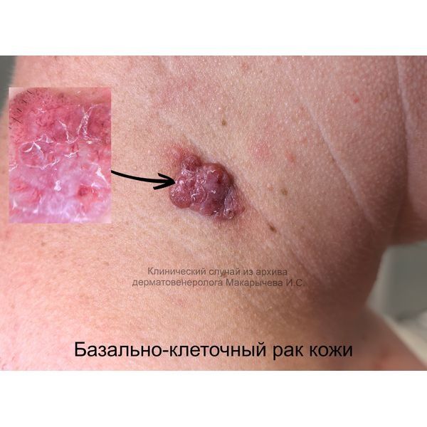 Очаг базалиомы на шее Очаг базалиомы на шее