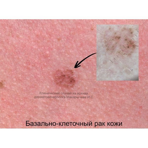 Очаг базалиомы в зоне декольте Очаг базалиомы в зоне декольте
