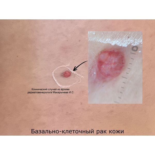 Очаг базалиомы на боку Очаг базалиомы на боку