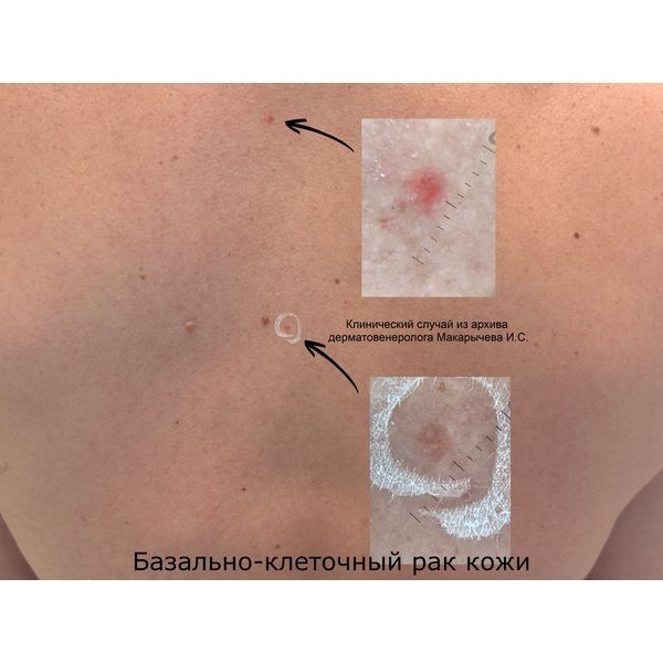 Очаги базалиомы на спине Очаги базалиомы на спине