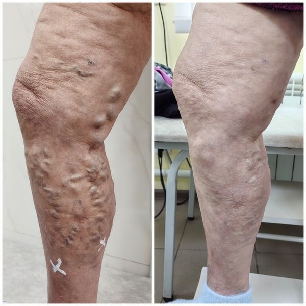 До и после лечения