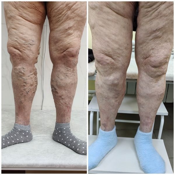 До и после лечения