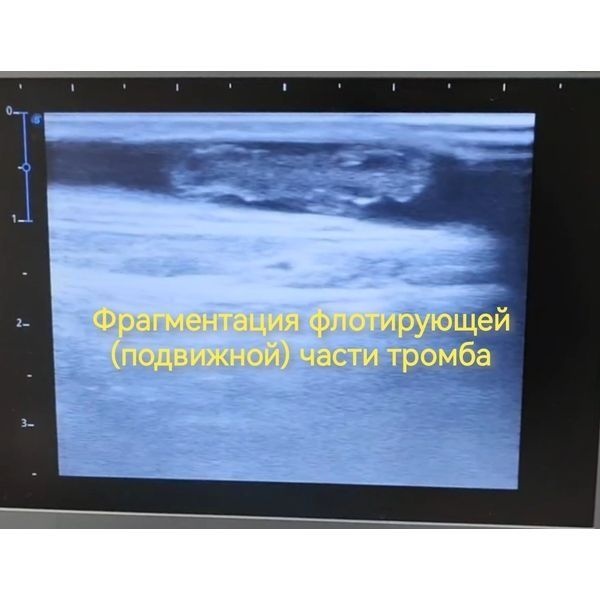 Фрагментация тромба