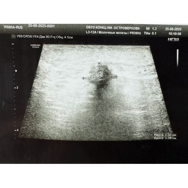 Очаговое образование правой молочной железы на УЗИ