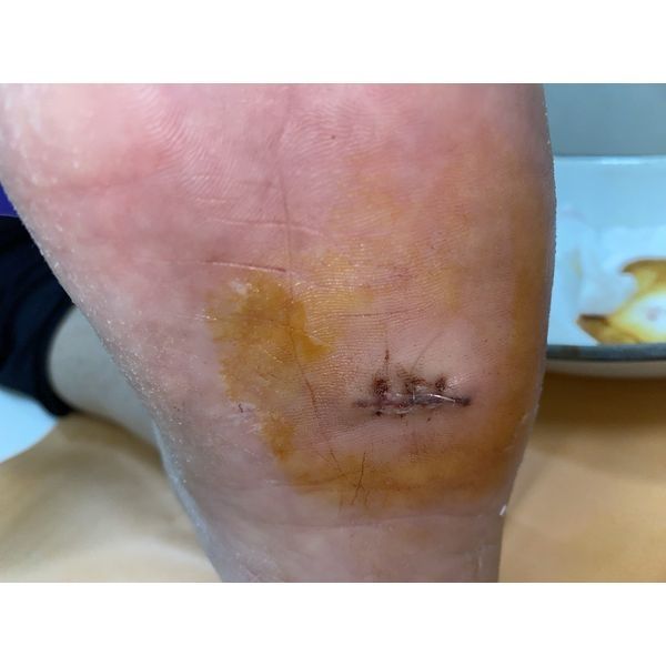 Шов на следующий день после операции 