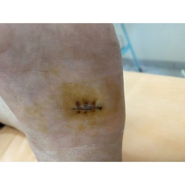 Рана после снятия швов