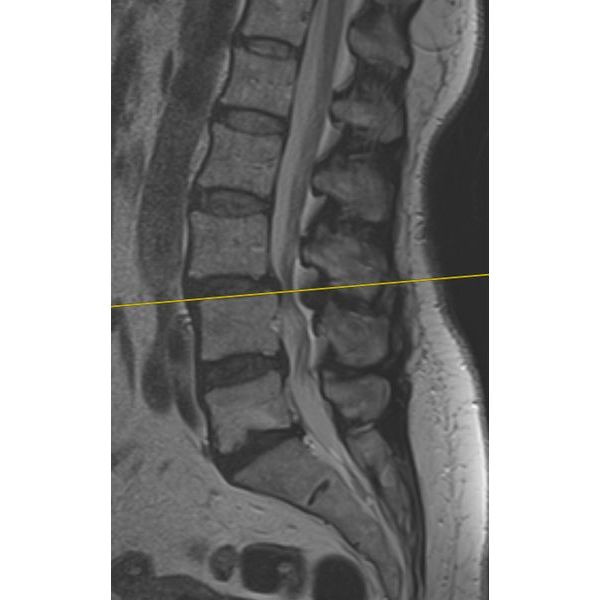 МРТ ПОП до операции в боковой проекции