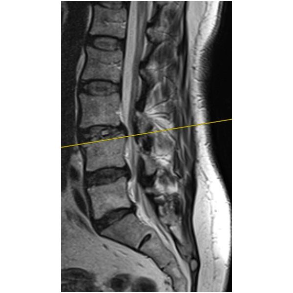 МРТ ПОП после операции в боковой проекции