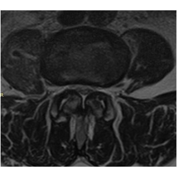 МРТ ПОП после операции в аксиальной проекции