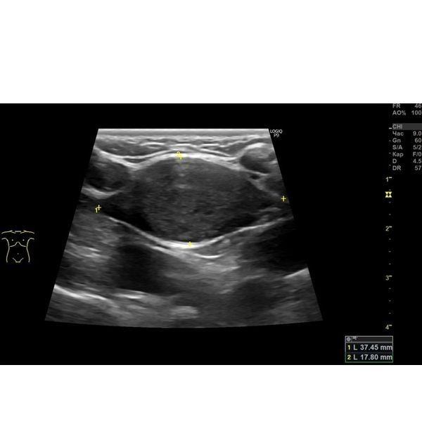 Снимок УЗИ от 8 августа 2023 года