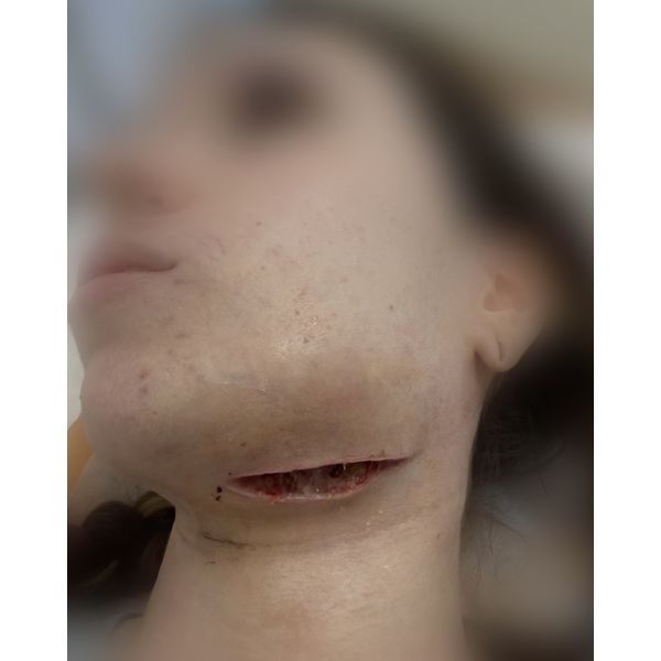 Состояние раны на четвёртый день после операции