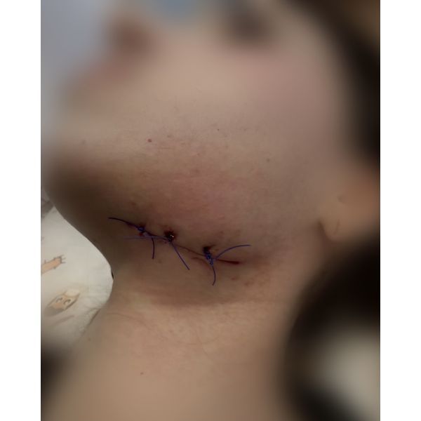 Состояние раны через неделю после операции