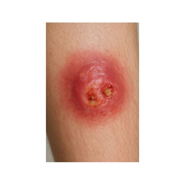 Карбункул Карбункул