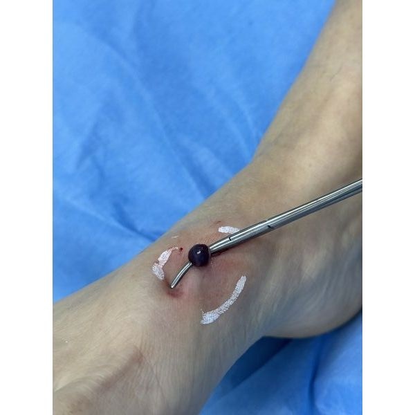 Выделение аневризматического мешка